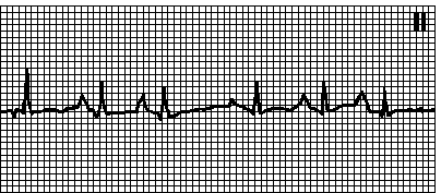 http://www.practica.ru/BK1/PIC/ECG/k014.gif